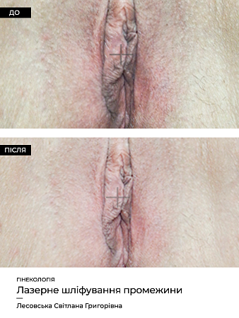 Лазерная фракционная шлифовка промежности фото до и после процедуры