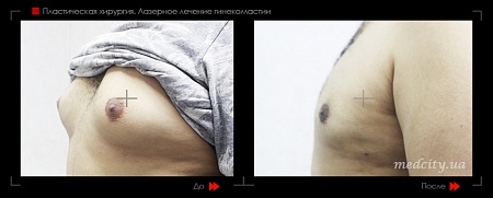 Гинекомастия 34 фото до и после процедуры