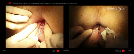 Удаление свища 2 фото до и после процедуры