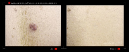 Удаление родинок14 фото до и после процедуры