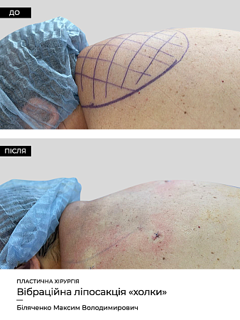 Лазерный липолиз горба фото до и после процедуры