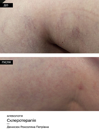 Склеротерапия 19 фото до и после процедуры