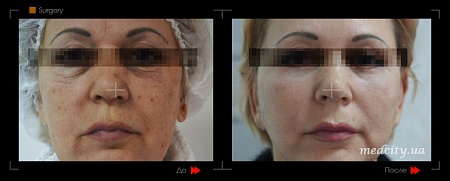 Podtyazhka Lica 1 фото до и после процедуры