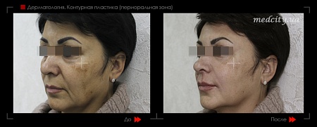 Контурная пластика периоральной зоны 3 фото до и после процедуры