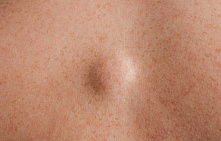 10% discount on lipoma, atheroma, hygroma removal.