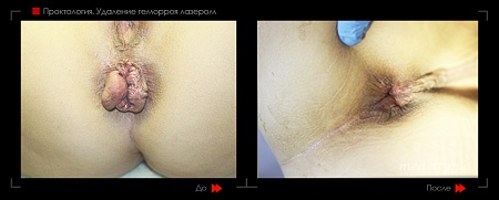 Удаление геморроя лазером 21 фото до и после процедуры