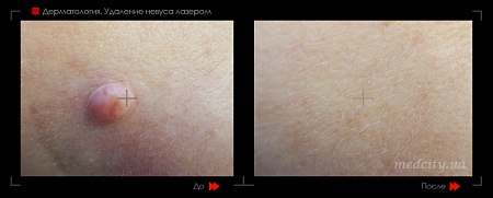 Удаление новообразования лазером 2 фото до и после процедуры