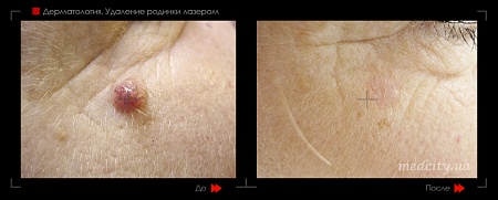 Удаление родинок 96 фото до и после процедуры
