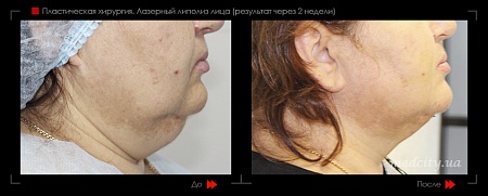 Липолиз лица 14 фото до и после процедуры