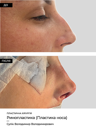 Ринопластика фото до и после процедуры