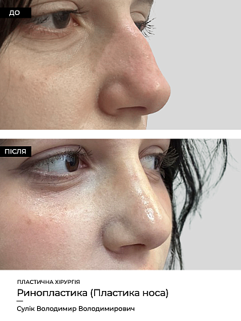 Ринопластика 17 фото до и после процедуры