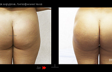 Липофилинг ягодиц