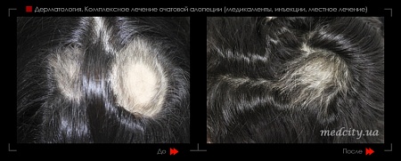 Лечение алопеции 2 фото до и после процедуры