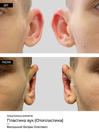 Отопластика 13 фото до и после процедуры