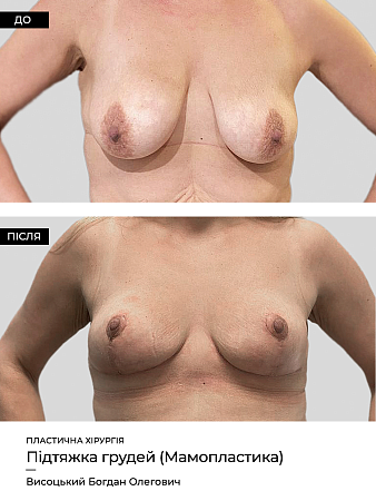 Коррекция ареол фото до и после процедуры