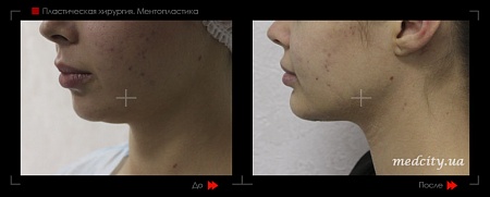 Ментопластика 3 фото до и после процедуры