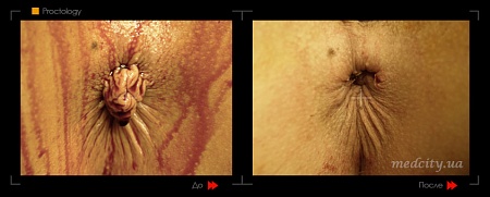 Lechenie gemorroya 2 фото до и после процедуры