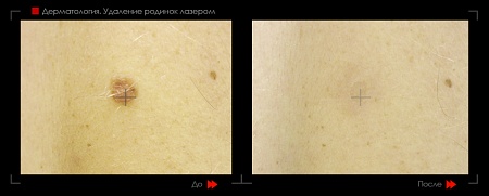 Удаление родинок 36 фото до и после процедуры