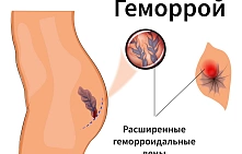 Что делать при геморрое