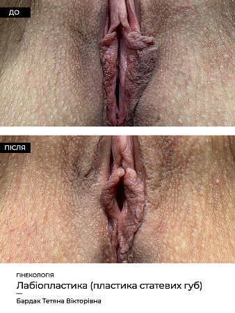 Лабиопластика 4 фото до и после процедуры
