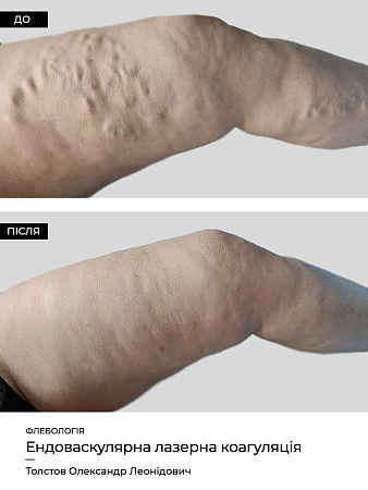 Эндоваскулярная лазерная коагуляция21 фото до и после процедуры