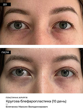 Блефаропластика нижних век фото до и после процедуры