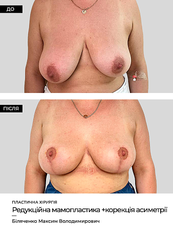 Зменшення грудей фото до и после процедуры