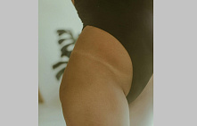 Подтяжка лобка (монспластика)