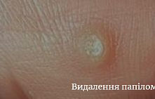 Видалення папілом