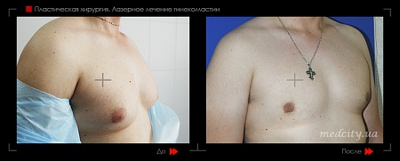 Гинекомастия 43 фото до и после процедуры