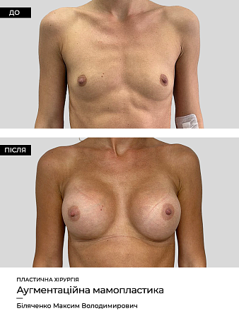 Маммопластика 19 фото до и после процедуры