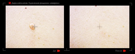 Удаление родинок 41 фото до и после процедуры