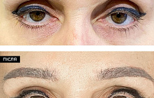 Как исправить птоз верхнего века?