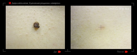 Удаление родинок 47 фото до и после процедуры