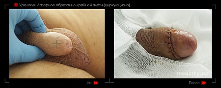 Лазерное обрезание крайней плоти 1 фото до и после процедуры