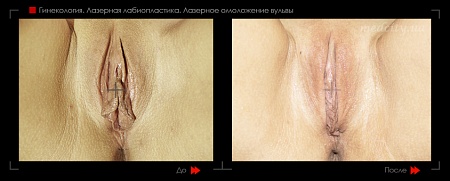 Лабиопластика 37 фото до и после процедуры