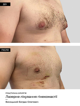 Гинекомастия 42 фото до и после процедуры