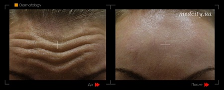 Korrekcyia morshin 2 фото до и после процедуры