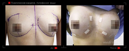 Липофилинг груди-5 фото до и после процедуры