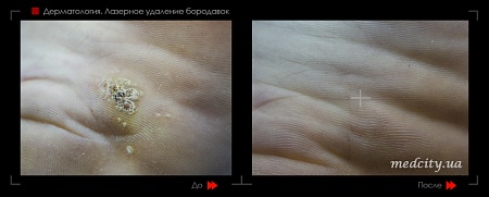 Лазерное удаление бородавок 7 фото до и после процедуры