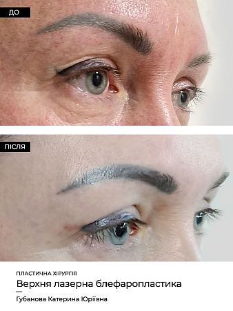 Блефаропластика 17 фото до и после процедуры