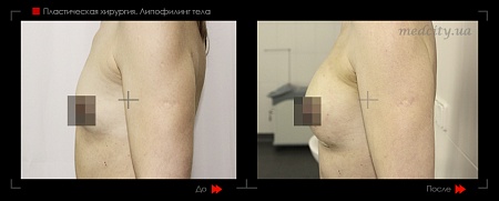 Липофилинг груди-2 фото до и после процедуры