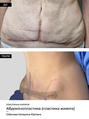 Абдомінопластика фото до и после процедуры