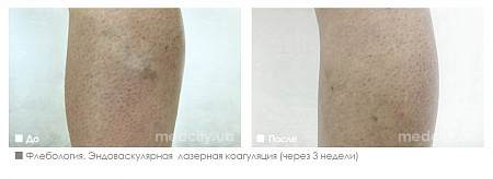 Эндоваскулярная лазерная коагуляция фото до и после процедуры