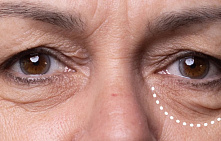 Грыжи под глазами