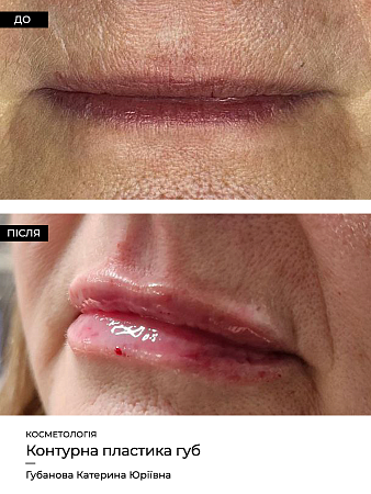 Увеличение губ 68 фото до и после процедуры