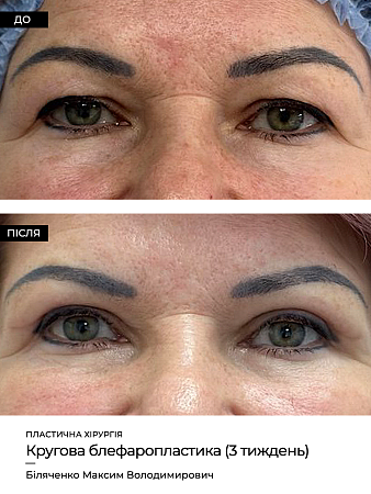 Блефаропластика фото до и после процедуры