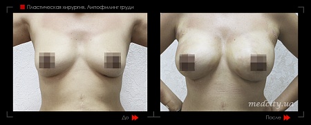 Липофилинг груди 9 фото до и после процедуры
