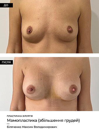 Маммопластика фото до и после процедуры