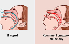 Как избавиться от храпа и почему это стоит сделать
